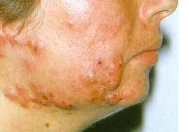 2/3 na kuur van 3-4 maand van acne