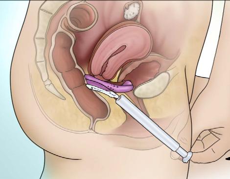6 13 Het Caya pessarium zit op de juiste plaats indien de cervix volledig door het pessarium is bedekt en het tussen de fornix posterior en de nis van