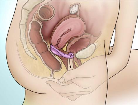 onafgedekte cervixkanaal naar de baarmoeder verplaatsen). Vervolgens wordt het Caya pessarium bij de vingergreep beetgepakt en uit de vagina getrokken.