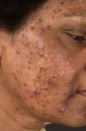Klinisch beeld van acne: