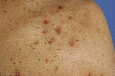 Klinisch beeld van acne: comedonen