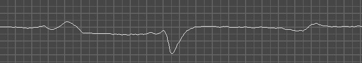 Totale amplitude QRS (mv) Afleidingen 1-8 Figuur 17: Box-and-whisker plot die de amplitude (gemiddelde ±
