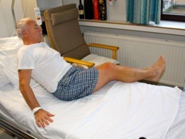 5 Praktische raadgevingen na een knieoperatie 5.1 Hoe gaan liggen in bed? Leg u zo goed mogelijk op de rug, het geopereerde been in het verlengde van het lichaam.
