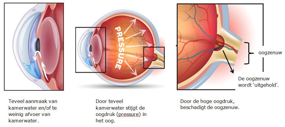 Glaucoom is een ziekte van het oog waarbij schade ontstaat aan de oogzenuw. Uw oogarts heeft met u besproken dat u een laserbehandeling voor glaucoom zult krijgen.