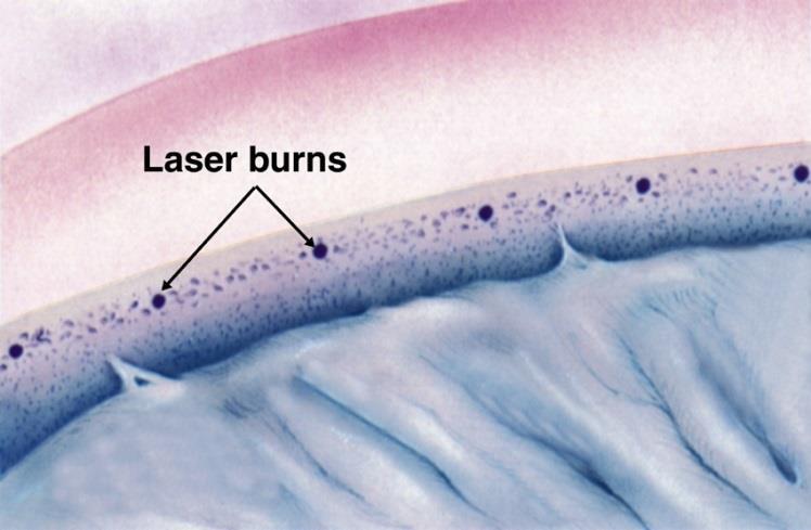 Laserbehandelingen: wat is het? Er zijn twee soorten laserbehandeling mogelijk. 1.