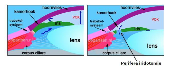 pupil wijd wordt. Als de oogarts ziet dat u risico heeft op acuut glaucoom, zal hij/zij laserbehandeling voorstellen.