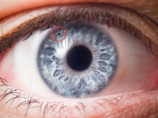 Bij acuut glaucoom wordt de afvoer van het kamerwater weer mogelijk via het gelaserde gaatje, en de oogdruk kan dalen.