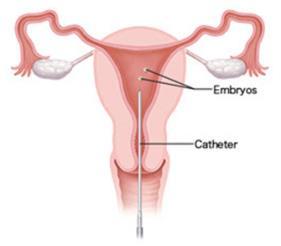 Opzuigen embryo in katheter
