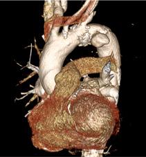 Aorta ziekten PAU (Penetrerend Atherosclerotisch Ulcus) Een aorta ulcus wordt