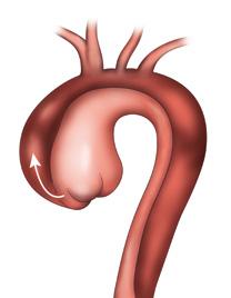 Aorta ziekten Een plots verschil in bloeddruk aan de armen vergezeld van pijnklachten kan duiden op een aorta dissectie.