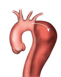 Aorta ziekten Dissectie "Type B dissectie" In tegenstelling tot een "Type A dissectie is een "Type B dissectie" een dissectie van de aorta descendens die begint per definitie na afgang van de linker