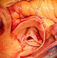 Aorta ziekten Bicuspide aorta klep Normaal bestaat de aorta klep uit drie klepslippen of cusps (tricuspide aorta klep). Een bicuspide aorta klep heeft in tegenstelling slechts twee functionele cusps.