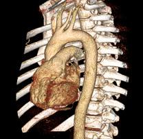 Diagnostiek Computed Tomography (CT) Computed Tomography (CT) is de belangrijkste techniek voor de diagnose van aorta afwijkingen zowel in geplande als spoed gevallen.