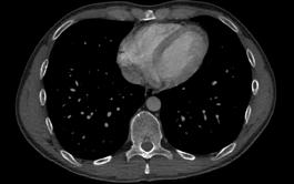 Diagnostiek 2D dwarsdoorsnede van de borst: bloedvaten met contrast (links) en longweefsel (rechts) In het algemeen, CT onderzoek is een laag risico procedure.