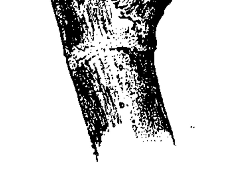 Plakoksel Een plakoksel is het raakvlak tussen de stam en een steil omhooggaande tak, waarbij de twee houtcilinders niet geheel vergroeien, omdat zich een laag bast tussen hen bevindt.