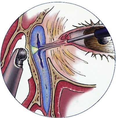 Endonasale DCR: de traanzak wordt geopend via de neus. Deze ingreep wordt uitgevoerd in het dagziekenhuis ; u kan diezelfde dag naar huis. Meestal wordt de patient onder algemene verdoving geopereerd.