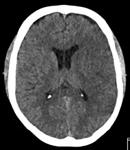 thrombolyse/thrombectomie