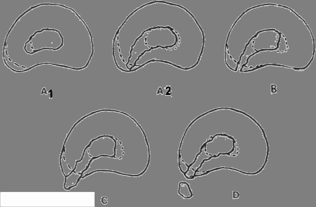 Figuur 9. A1: lichte protrusie. A2: duidelijke protrusie. B: prolaps. C: extrusie. D: sequestratie.