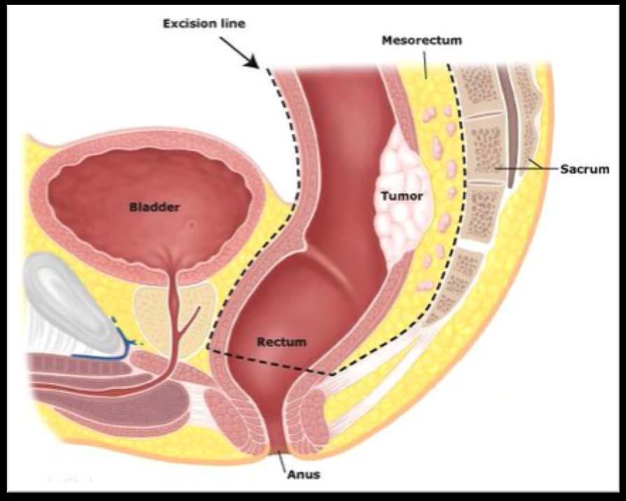 TME (Totale Mesorectale Excisie) Verwijdering van