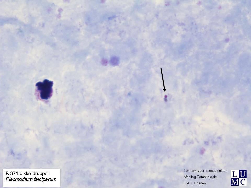 Casus B-371 Een Afrikaanse patiënt met malaria wordt een dag na start van de behandeling onderzocht. Materiaal: Giemsa-gekleurde dikke druppel en uitstrijk op een glaasje.