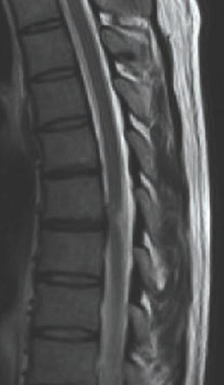 lumbosacrale wervelkolom, een MRI-scan van hersenen en liquoronderzoek toonden geen van alle bijzonder heden. Een MRI-scan van de thoracale wervelkolom was in die periode niet aangevraagd.