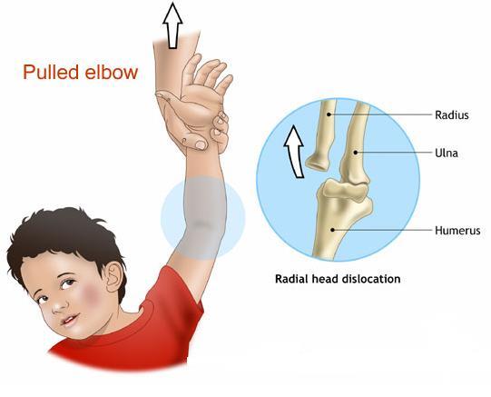 EHBO bij het zondagmiddagarmpje (subluxatio capitelli radii) Komt vaak voor bij kinderen van 3-6j Elleboog is uit de kom