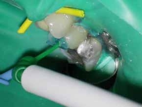 biocompatibiliteit Bij endodontische vulmaterialen die vele jaren in het lichaam blijven is het belangrijk dat er geen