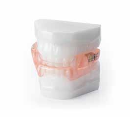 Levertijden FlitZ -prothese dagen Digitale goedkeuring 3 Afmaken 6 Met slechts twee bezoeken aan de tandarts heeft u binnen twee weken een nieuw kunstgebit.