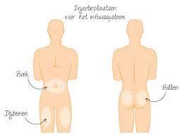 Zo voorkom je lipo s: Wissel de plaats van je infuusnaald af (links-rechts) Roteer binnen de injectieplaatsen Wissel je pod iedere 3 dagen Let op: Het tijdstip van het verschonen zo kiezen dat er de