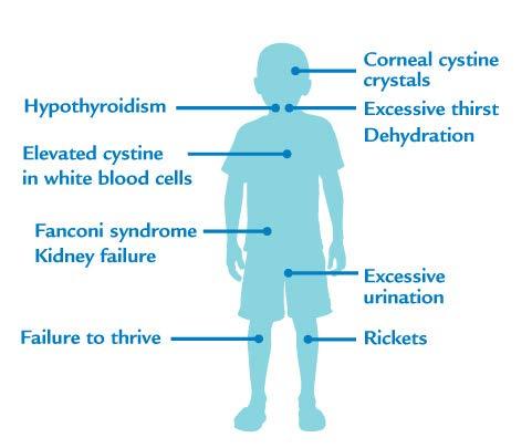 Nephropatische Cystinose Syndroom van Fanconi Start rond een leeftijd van 6