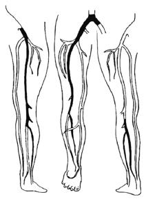 Figuur 1 Proximale DVT (links), bekkenvenentrombose (midden) en distale DVT (rechts) recente operatie, trauma aan het been, oestrogeengebruik (al dan niet in combinatie met progestagenen),
