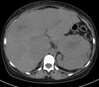 vage last rechter hypochonder, rash, maagpijn Biochemie: gestoorde leverset Geen macroscopische hematurie Echo abdomen: niertumor