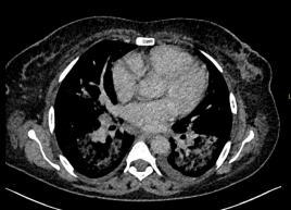 Thorax-Abdomen: Casus gemetastaseerd niercelcarcinoom (2) Diagnose: uitgebreide niertumor links Adenopathieën Levermetastasen