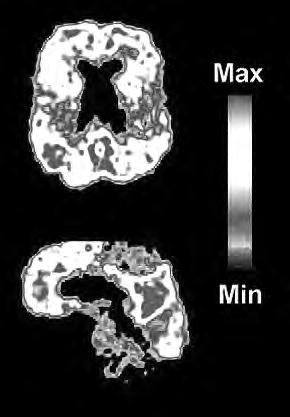 Opgave 2 PET-scan Bij onderzoek naar de ziekte van Alzheimer figuur 1 wordt de PET-scan gebruikt. Daarbij spuit men bij de patiënt een speciale stof in die het C-11-isotoop bevat.