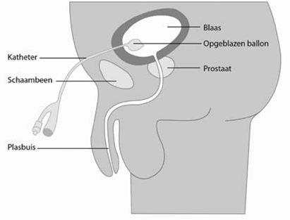 Urineretentie Definitie