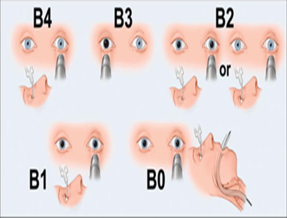 FOUR-score: Hersenstamreflex: 4= pupil reactie en cornea reflex aanwezig 3= één pupil wijd en stijf 2= pupil reactie of