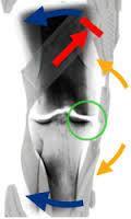 Over de knie(2) Fysiotherapie met mobilisatie knie, bewegen, looptraining(+/- krukken) heeft zin! Oefentherapie alleen net zo goed!(ft J. Knoop, VUmc). Spierversterkende oef.