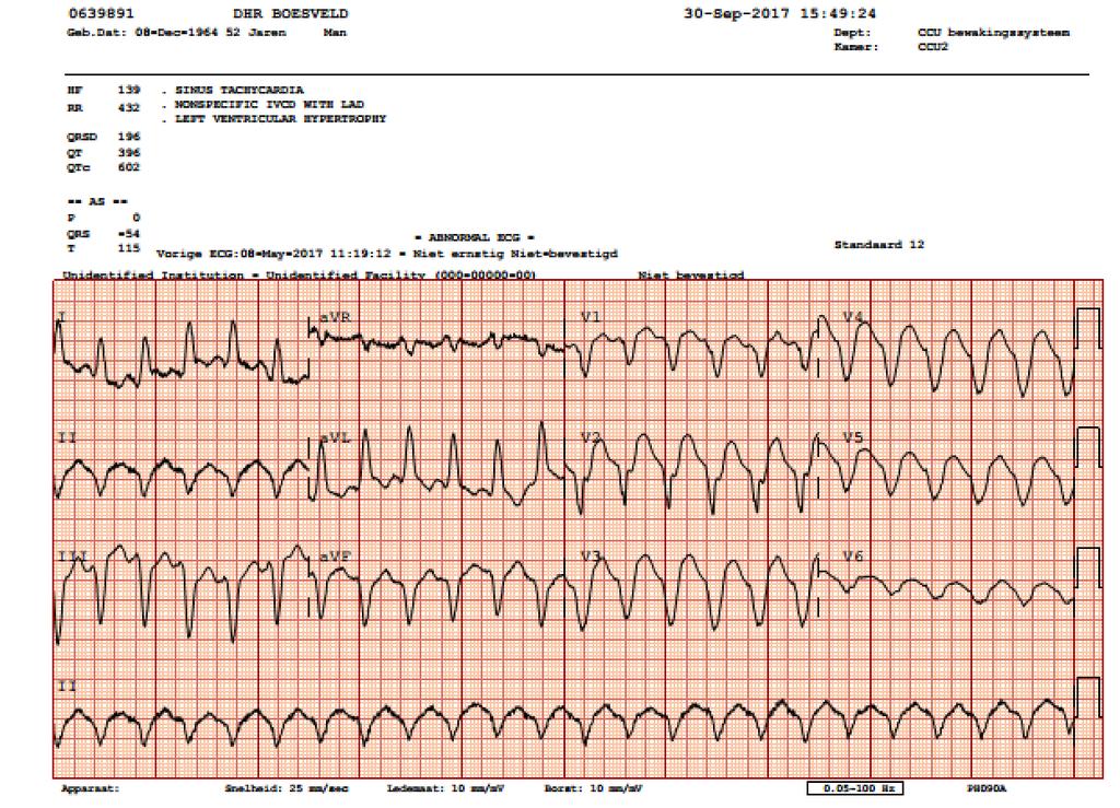 Breed-complex tachycardie (140/minuut) Linker hart as LBTB patroon met