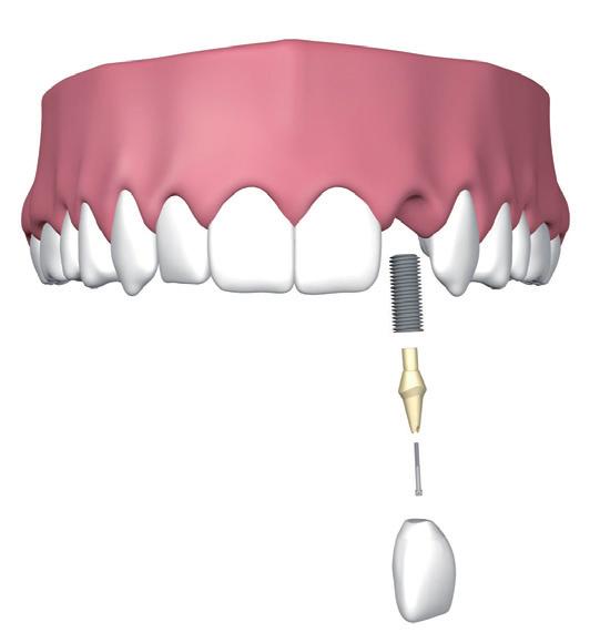 Begonnen wordt met het verwijderen van de tand. Om het omgevende bot zo min mogelijk te kwetsen wordt de tand vaak met een boortje in tweeën gesplitst zodat deze er in stukjes uitgehaald kan worden.