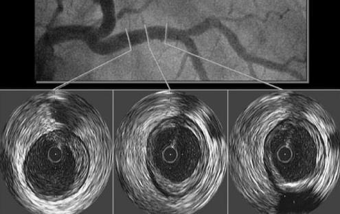 IVUS in women with angina and non-obstructive CAD (NOCAD):