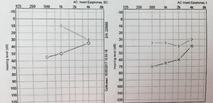 gedragsaudiometrie Audiometrie pas betrouwbaar op leeftijd 18 maand na meermaals testen en 2x herplaatsen van diabolo s (factor