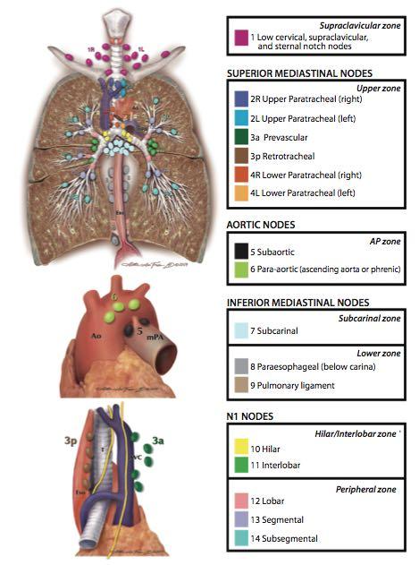 International Association for the Study of Lung Cancer Nodal Chart