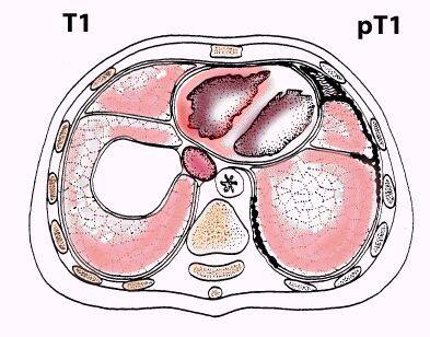 No involvement of visceral pleura tumour involves ipsilateral parietal (mediastinal, diaphragmatic) pleura with focal involvement of the visceral pleura Tumour involves any ipsilateral
