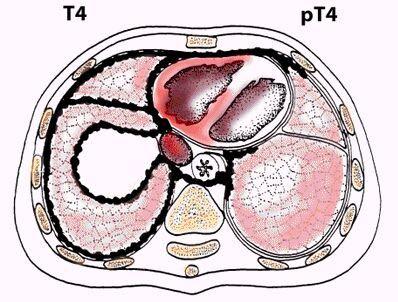 contralateral mediastinal, internal mammary, or hilar node(s) and/or ipsilateral or