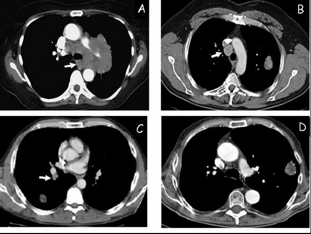 Nieuwe Belgische richtlijnen over de plaats van EUS en EBUS bij mediastinale staging Groep A: tumor met bulky invasie van het mediastinum: doel is enkel APD diagnose te bekomen en dit kan via EUS of