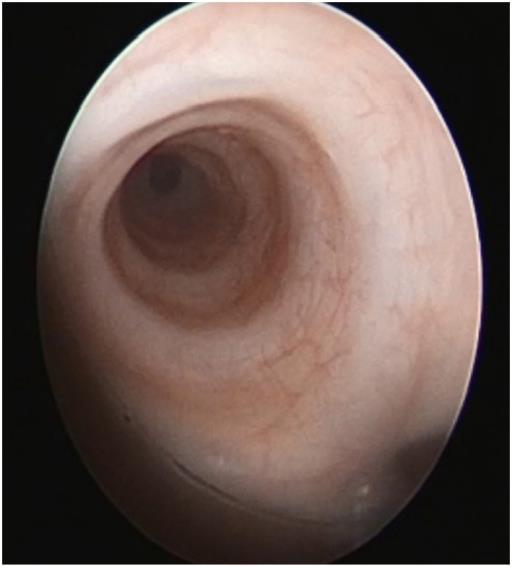 Hoge luchtwegobstructie Trachea Congenitale tracheastenose rigide vernauwing trachea Tracheamalacie