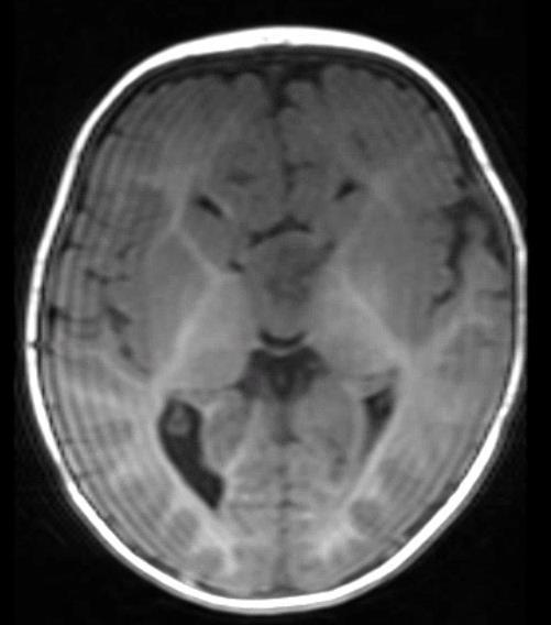 MRI brain in