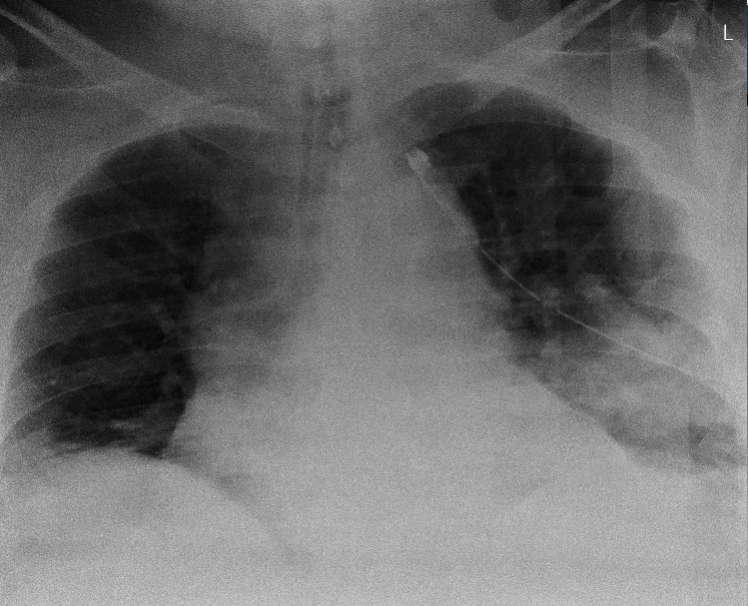 X-thorax patiënt X op