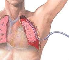 Thoraxdrain op SEH Indicaties: pneumothorax,