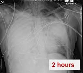 EAST Practice Management Workgroup for Pulmonary Contusion-Flail